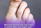 Pharmacist reveals two w:arning signs of silent k𝓲llєr that you might spot in your feet #6